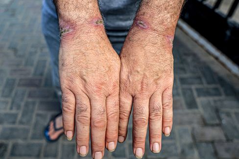 A Palestinian showing wounds on his wrists, likely caused by zip ties.